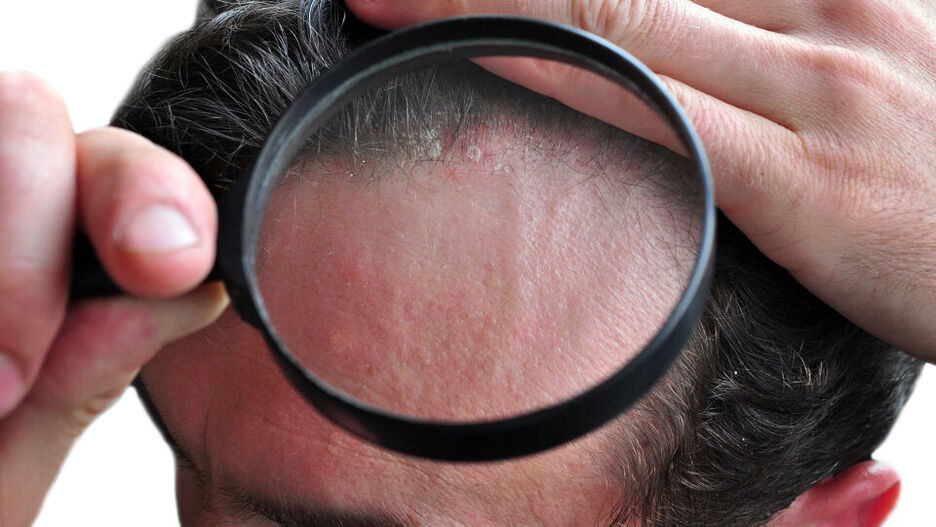 Ein Mann zeigt mit einer Lupe, dass auch seine Kopfhaut von Schuppenflechte betroffen ist.
